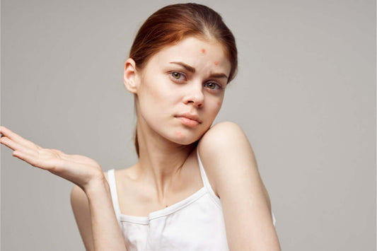 Da mụn nên ăn gì? 5 nhóm thực phẩm giúp hỗ trợ điều trị mụn