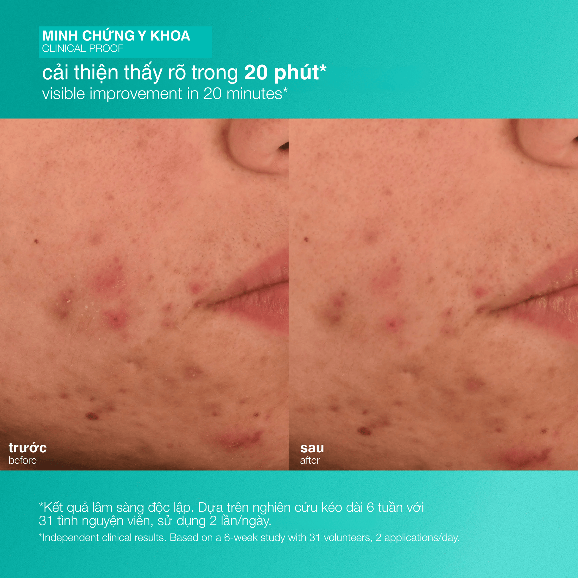 Dermalogica Vietnam MOISTURIZERS Fullsize 50ml sắp ra mắt...dưỡng ẩm giảm mụn breakout biotic moisturizer